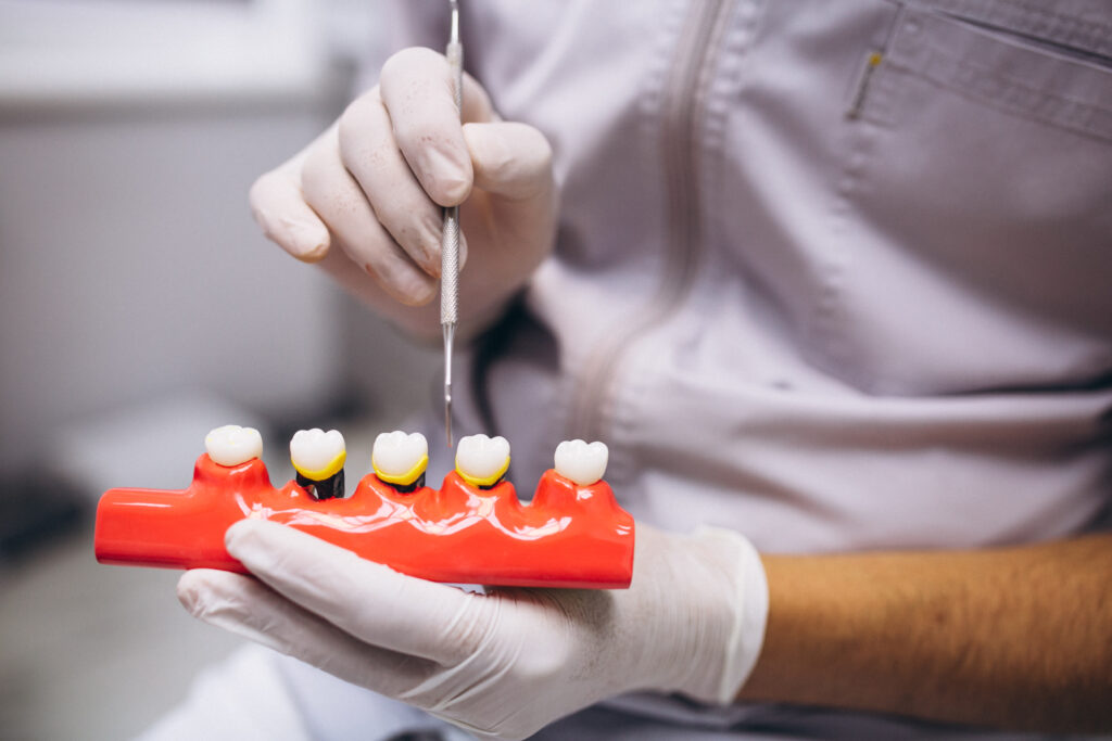 ¿Qué Tipo de Corona Dental es Mejor? Guía Completa para Elegir la Opción Ideal